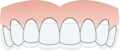 Invisalign