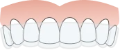 graphic of teeth with Invisalign Aligners