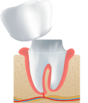 dental crowns