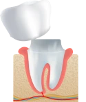 graphic of veneers and crown
