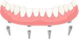 Dental implants