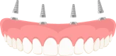 Denture Implants graphic